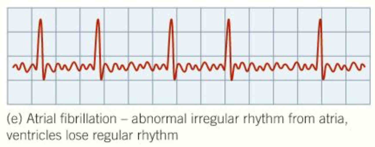 <ul><li><p>example of arrhythmia </p></li><li><p>rapid electrical impulses in atria <strong>fibrillate</strong> but to 400 times a minute </p></li><li><p>don’t contract properly and only some of impulses are passes on to the ventricles, <strong>heart does not pump blood very effectively </strong></p></li></ul>