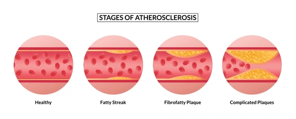 <p>Atherosclerosis</p>