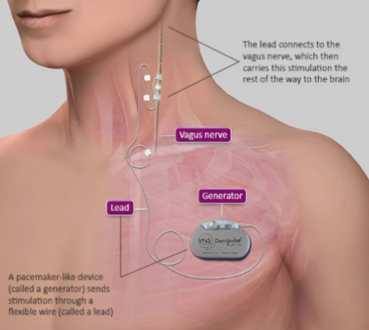 <ul><li><p>Adjunct to medications when surgery is not feasible</p></li><li><p>Exact mechanism not known</p></li><li><p>Thought to interrupt synchronization of epileptic brain-wave activity and stop excessive discharge of neurons</p></li></ul><p></p>
