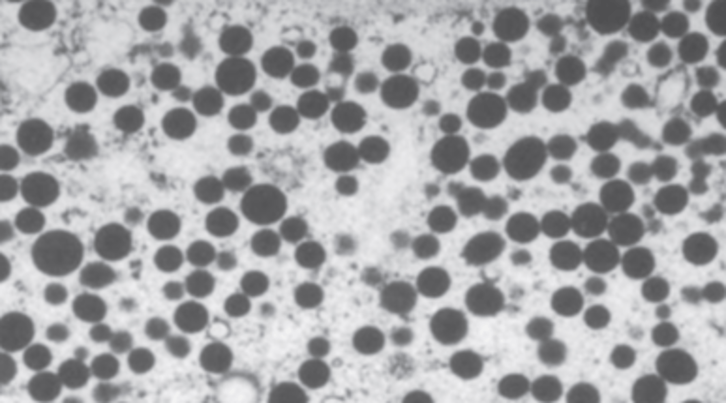 <p>A 59-year-old man complains of weakness and 5 kg (11 lb) weight loss during the past month. An abdominal CT scan suggests metastatic cancer involving the liver and the retroperitoneum. A CT-guided biopsy displays a poorly- differentiated neoplasm. Electron microscopy of the biopsy is shown. Which of the following organs is the most likely primary site for this patient's malignant neoplasm?</p><p>(A) Adrenals</p><p>(B) Kidneys</p><p>(C) Prostate</p><p>(D) Testes</p><p>(E) Thyroid</p>