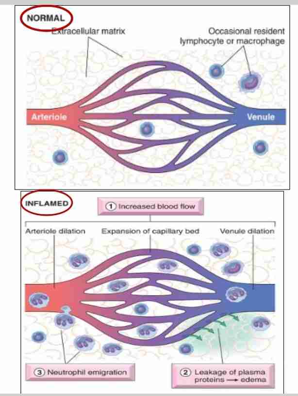 <ol><li><p>First involves arteriole and then leads to opening of new capillaries beds in area</p></li><li><p>Increased blood flow</p></li><li><p>Heat and redness (erythema) at site of inflammation </p></li><li><p>Mediators: histamine, prostaglandin and nitric oxide (NO), on vascular smooth muscle </p></li></ol>
