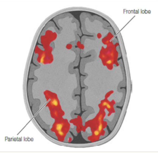 <p><span>The Parieto-Frontal Integration Theory (P-FIT): </span></p>