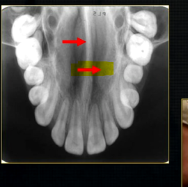 <p>less dense opacity is caused by the </p>