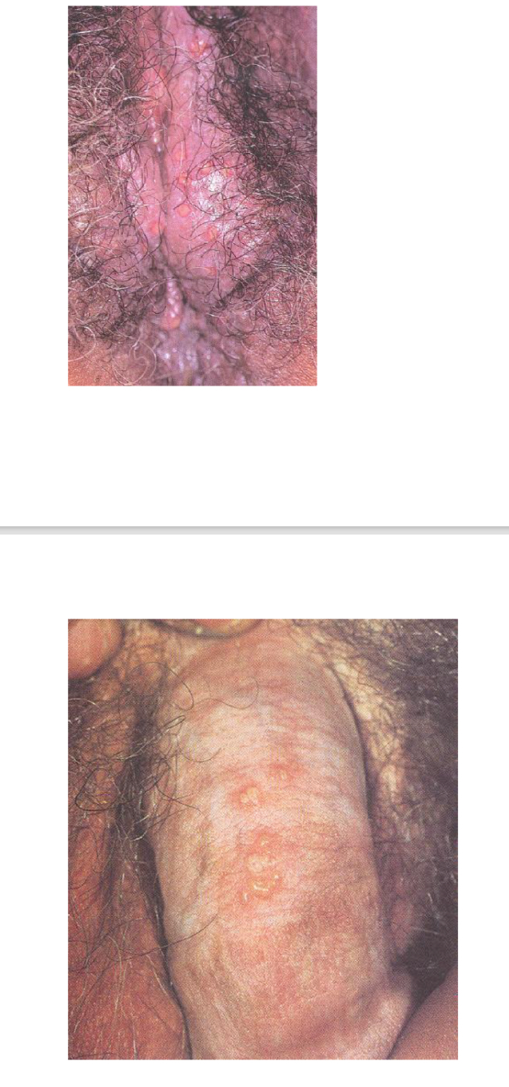 <p>what infection is this caused by </p>