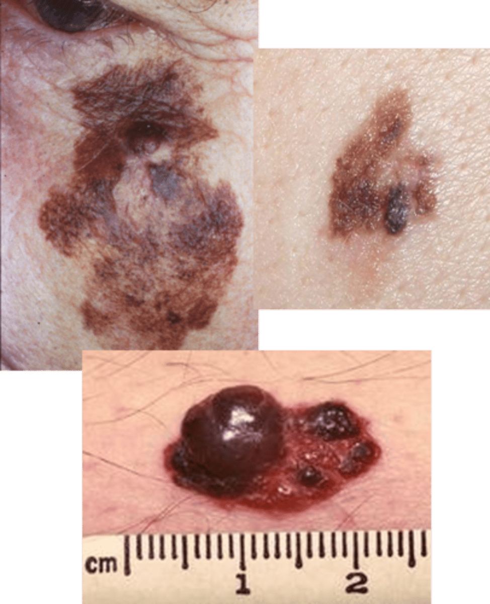 <p>Dysplastic nevus</p>
