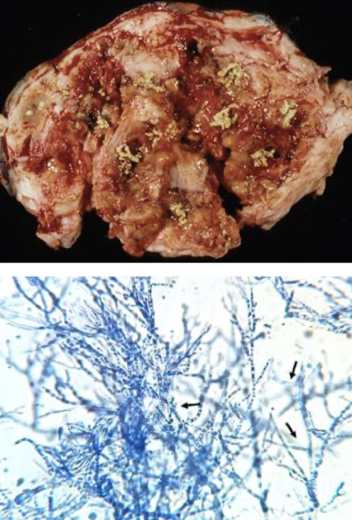 <p>Forms granulomatous, ulcerated nodules resembling tumors with gray-yellow necrotic <strong>“kunkers.”(are pathognomonic) </strong>Common on limbs, chest, or abdomen. Lesions are locally invasive and non-healing</p>
