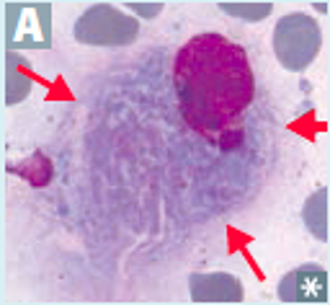 <p>Beta glucosidase deficiency, can't break down glucocerebroside, leading to lipid accumulation in macrophages<br>-Characterized by WRINKLED TISSUE PAPER LOOK in cytoplasm <br>-leukemia, splenectomy, and anemias</p>