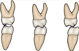 <p>Refers to the place where the teeth occlude at the occlusal surface. </p>
