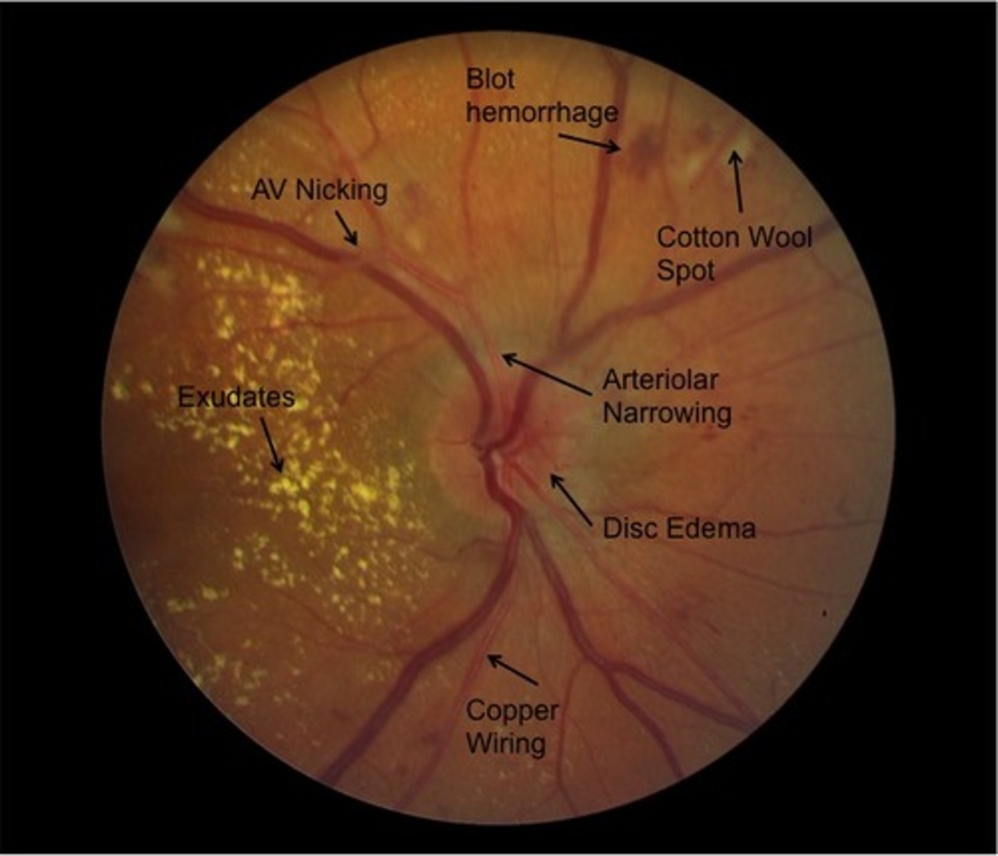 <p>Findings include arterial vasoconstriction, arteriosclerosis (copper wiring), arteriovenous (AV) nicking, focal axonal swelling (cotton wool spots), and exudation (macular star).</p>