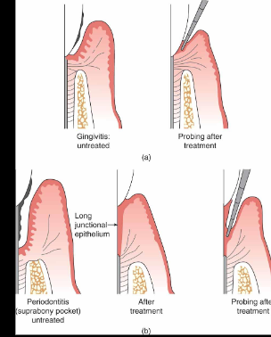 <p><span style="color: red"><strong>REPAIR ≠ REGENERATION</strong></span></p><p><strong>Non-surgical (Periodontal Debridement/NSPT):</strong> removal of plaque biofilms, calculus, and contaminated cementum → eliminates inflammation and <strong>allows tissues to REPAIR</strong></p><p><strong>Surgery: attempts are made for REGENERATION</strong></p><div data-type="horizontalRule"><hr></div><p><strong>Connective Tissue Attachment Level: </strong>the level on the root at which the most coronal fibers are attached (histologically); corresponds roughly to the base of the pocket as identified by probing in periodontitis</p><ul><li><p>a “gain” in clinical attachment refers to a <strong>DECREASED PENETRATION OF THE PROBE</strong> at the base of the pocket after tx,<strong> NOT new connective tissue attachment</strong></p></li><li><p><span style="color: red"><strong>reduction of pocket depths = long epithelial attachment (NO real CT attachment is reformed — the JE is a weak attachment and can easily let go, contributing to the pt’s high susceptibility for recurrence of periodontitis)</strong></span></p></li></ul><p><strong>Factors Affecting CAL Measurement:</strong></p><ul><li><p>pseudopocket (gingival inflammation = coronal migration of FGM)</p></li><li><p>probing technique (overangulation, pressure and integrity of JE)</p></li><li><p>tooth anatomy</p></li><li><p>presence of calculus (probe hits calc and not the pocket base)</p></li><li><p>reduction in PD due to recession and/or an increase in clinical attachment via the top of a long JE</p></li></ul><p></p>