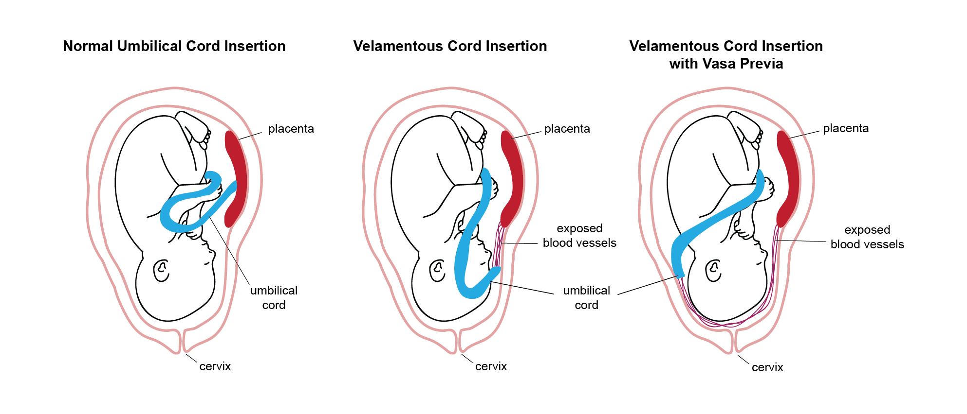 <p>Velamentous Cord Insertion</p>