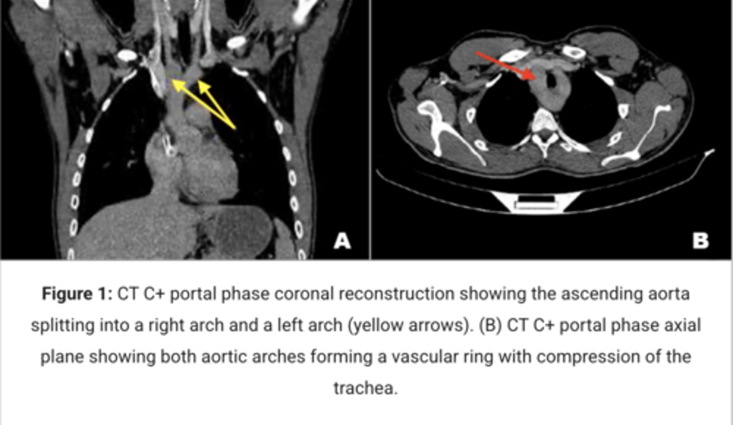 <p>Persistence of both right and left aortic arches forming a vascular ring.</p>