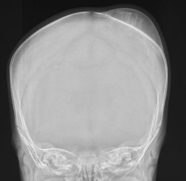 <p>cephalohematoma</p>