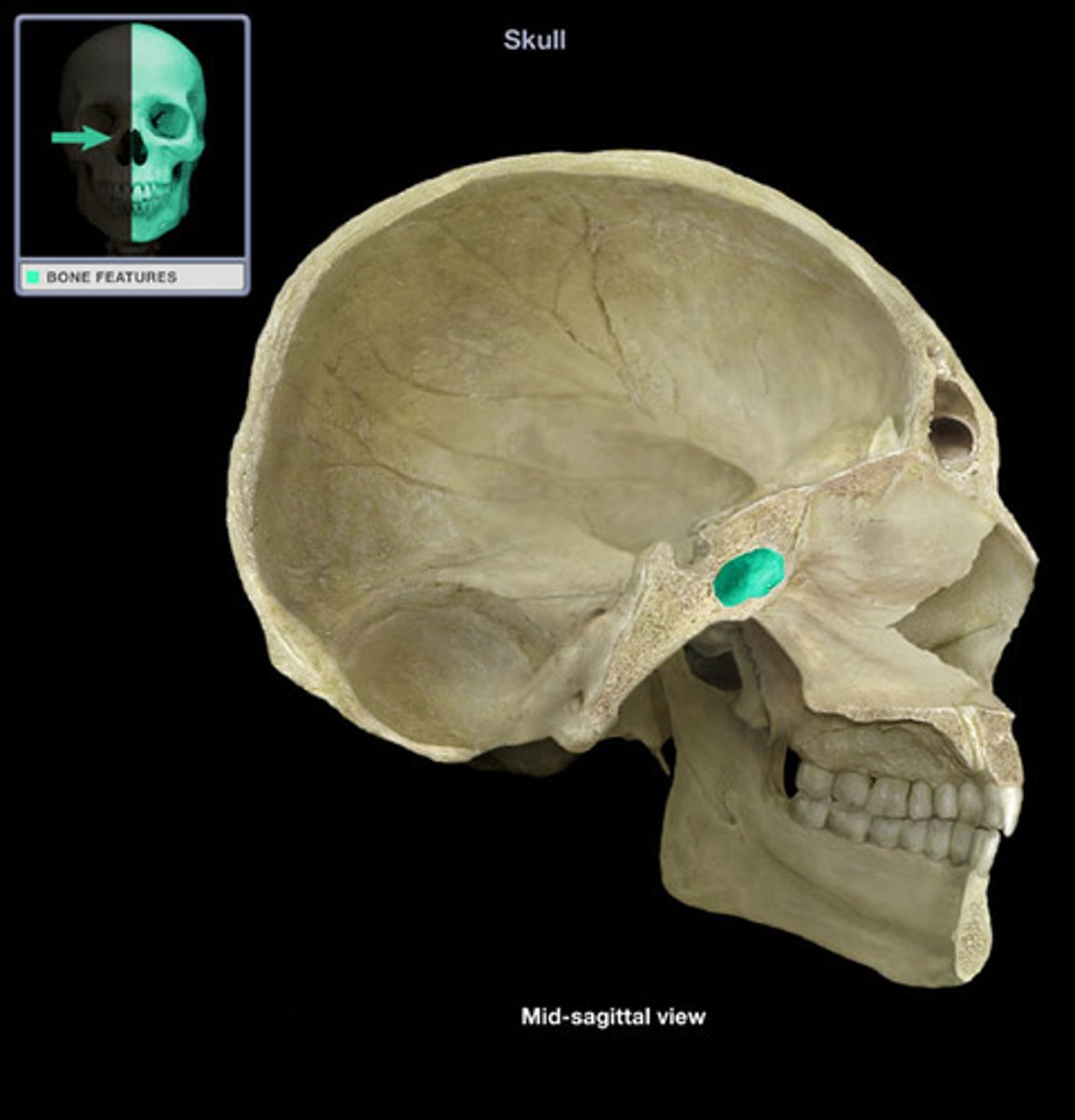 <p>only thin plates of bone separate it from many important structures; not seen until 2 years old</p>