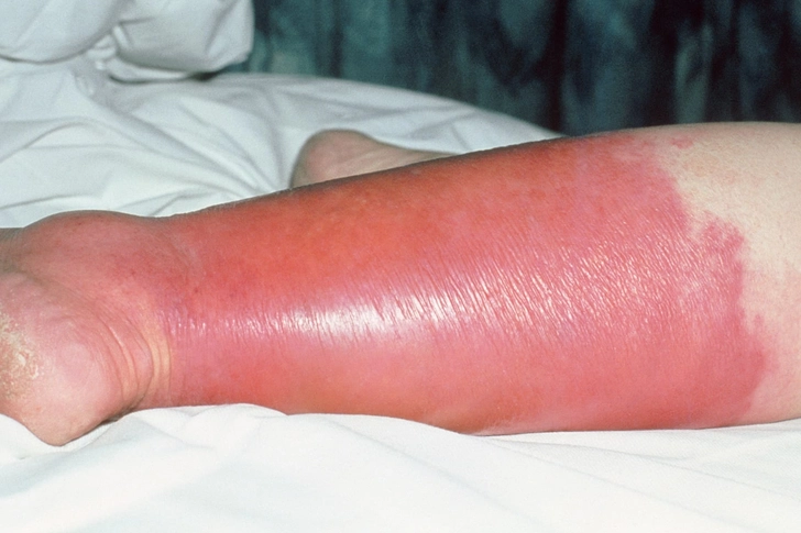 <p>Cellulitis</p>
