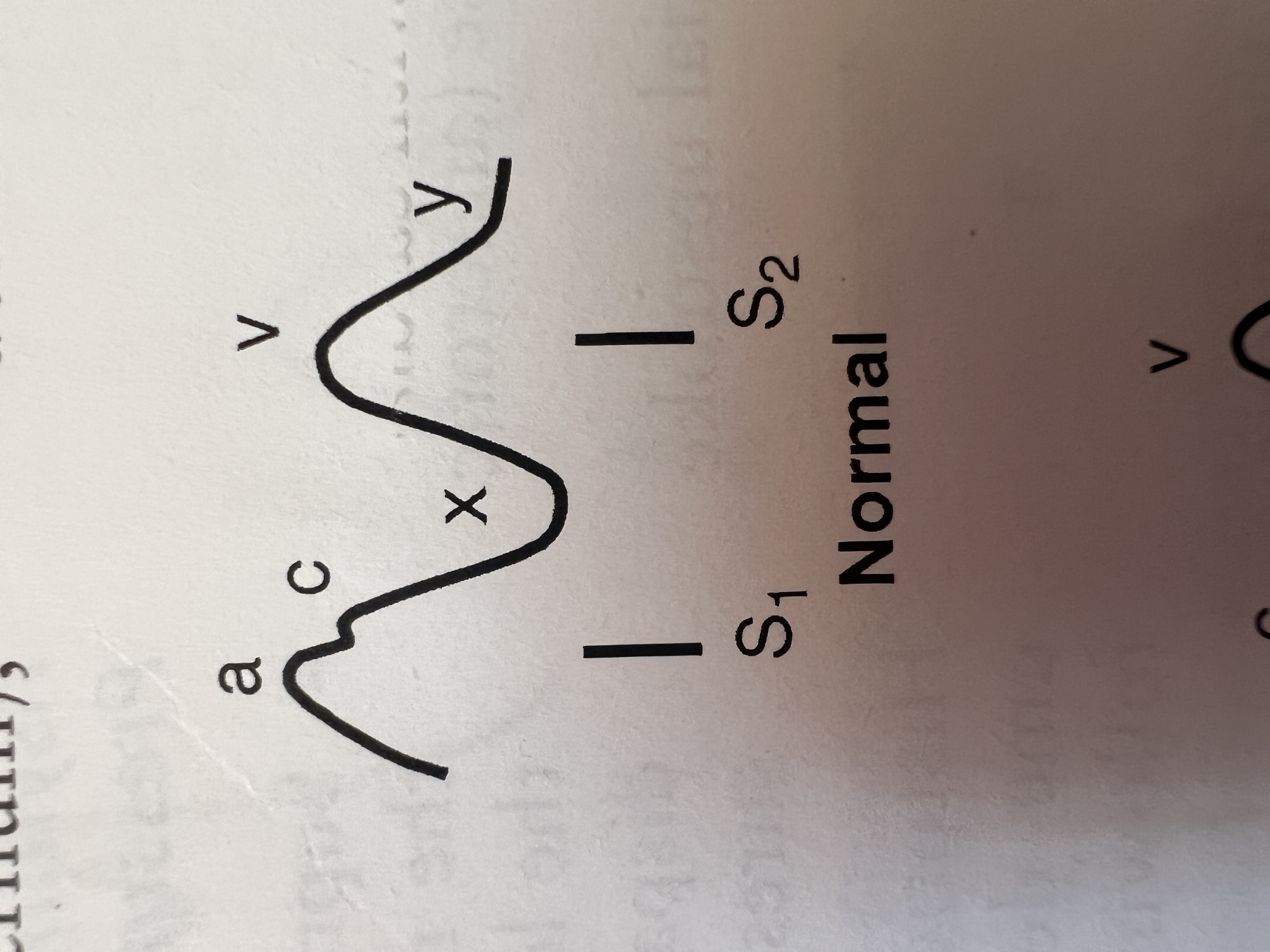 <p>Decrease in right atrial pressure with right atrial/annular relaxation during right ventricular systole.</p>