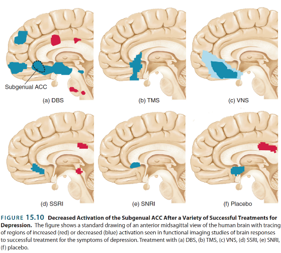 <p>Stress sresponce is an important aspet of depoersion</p><p class="MsoNormal">Reduction in activation of stressresponce- more effective trments</p><p class="MsoNormal">subjenial antiral cortex - reduce activity in </p><p class="MsoNormal">Decrese in activation of stress responce</p>