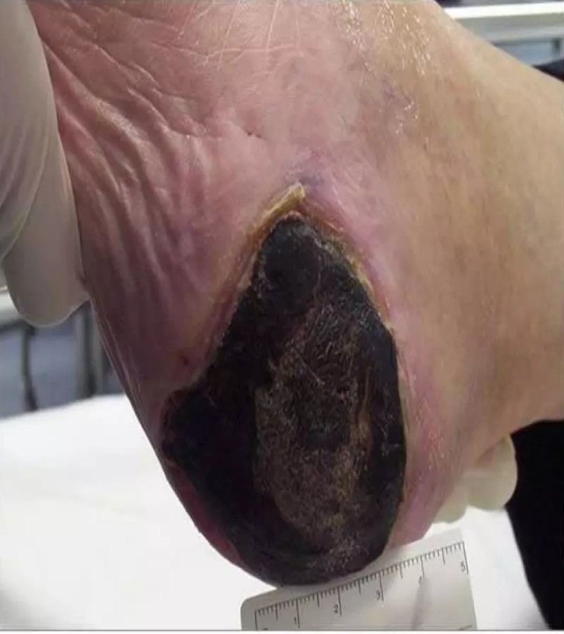 <p>Unstageable “Eschar”</p>