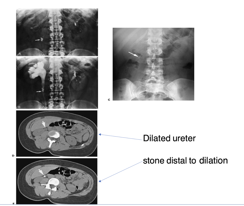 <p><strong>Dilated renal collecting system</strong>, hydronephrosis, or hypofunction of the affected kidney. </p>