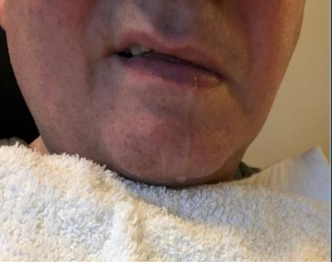 <p>What is the treatment for sialorrhea?</p>