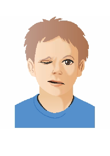 Was ist dies für eine Gangstörung? und was ist die Erklärung und die Krankheitsbilder?