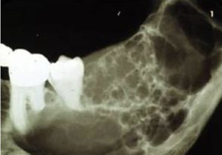 <p>Multiple unilocular lesions that are somewhat fused together, making up the entire lesion, sometimes described as resembling soap bubbles</p>