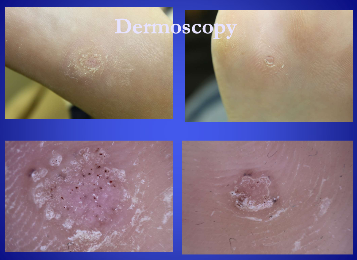 <p><span><strong>[...]</strong> useful to distinguish warts from corns&nbsp;</span></p>