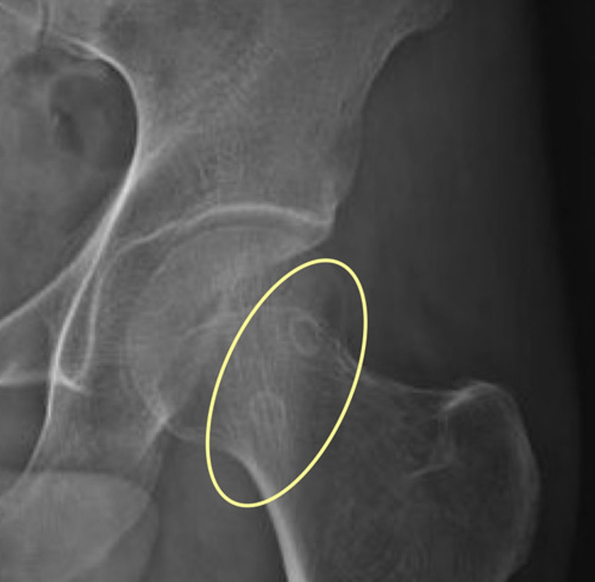 <p>Notice denser, cortical bone around the pit</p>