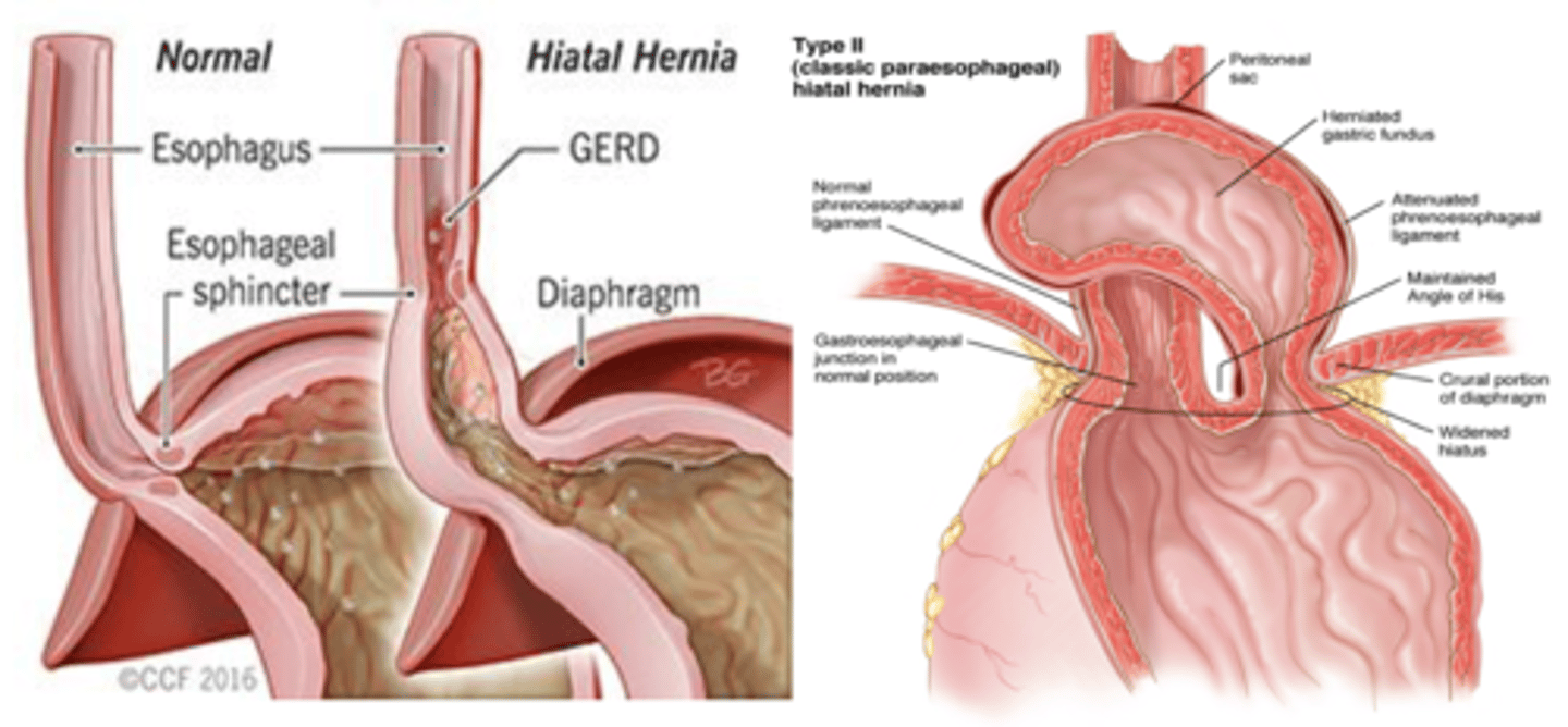 <p>Paraesophageal Hiatal Hernia</p>
