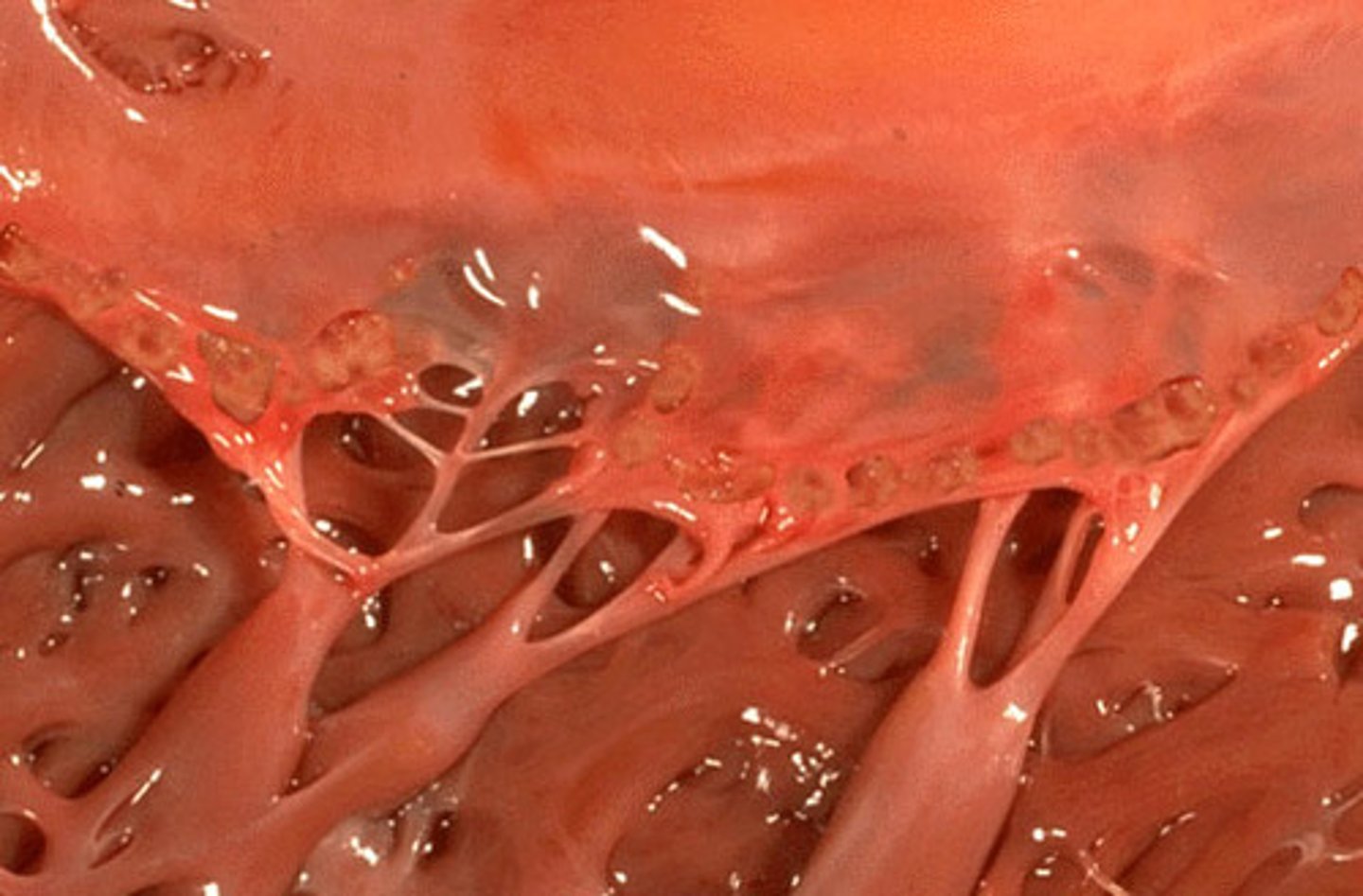 <p>(pan-kahr-DAHY-tis) Inflammation of the entire heart (ការរលាកបេះដូងគ្រប់ស្រទាប់)</p>