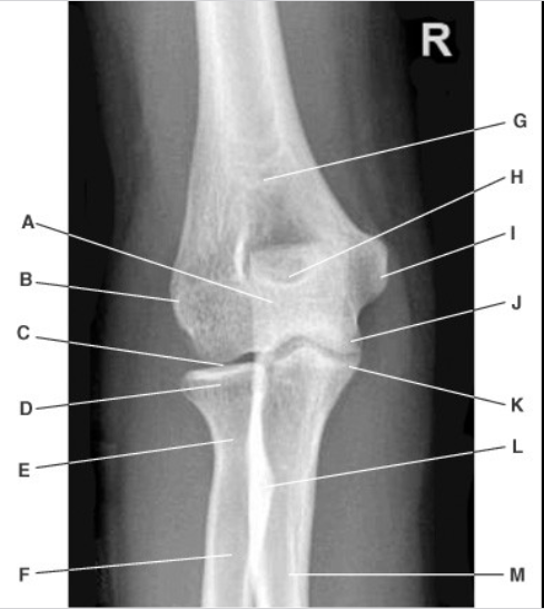 <p>In this AP Elbow projection, what is indicated by label C?</p>