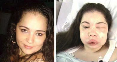 <p>recurrent episodes of angioedema, which most often affect the<br>skin and mucosal tissues of the upper respiratory and gastrointestinal tracts</p><p><span>Although the swelling is self-limited, laryngeal involvement may cause fatal</span><br><span>asphyxiation.</span></p>