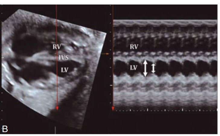 <p>M-mode measurement of the fetal heart.IVS = </p>