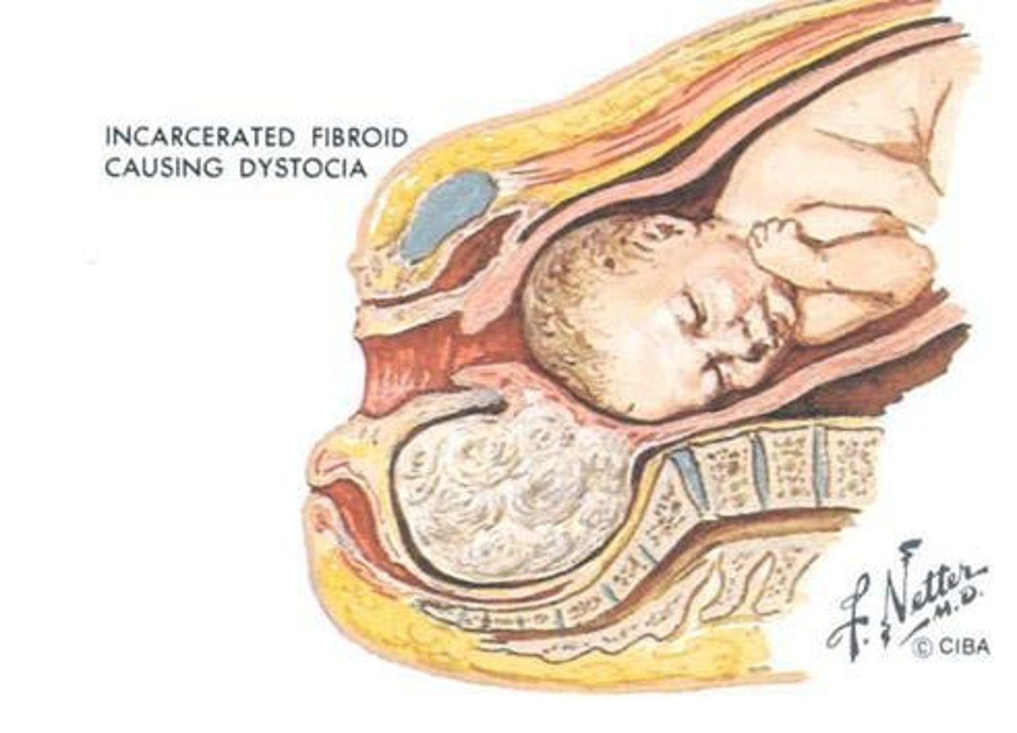 <p>- Dystocia: difficult birth from fibroid compressing lower uterine segment</p><p>- Cystic degeneration of fibroid: could cause pain (inc estrogen from preg = inc size of fibroid)</p>
