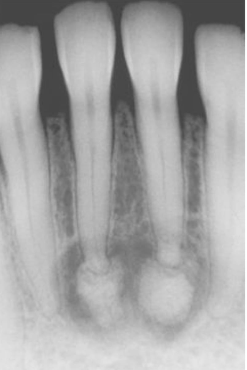 <p>common locations: anterior mandible of periapical region</p><p>clinical features: asymptomatic; vital teeth</p><p>radiographic: early lesions are radiolucent, then they become mixed, then they become radiopaque; the PDL is still intact</p><p>population: middle aged adults; females 14:1; black females</p>