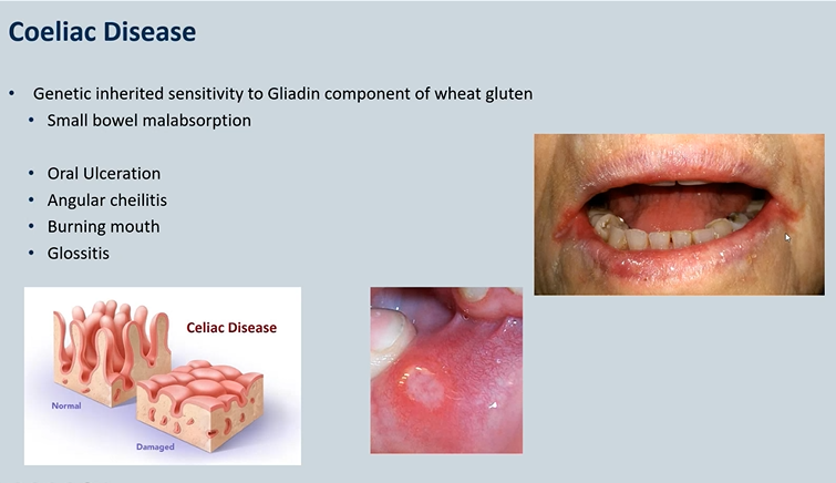 <ul><li><p>Genetic inherited sensitivity to Gliadin component of wheat gluten Small bowel malabsorption - villus atrophy </p></li><li><p>Oral Ulceration </p></li><li><p>Angular cheilitis - candida infection </p></li><li><p>Burning mouth </p></li><li><p>Glossitis</p></li></ul><p></p>