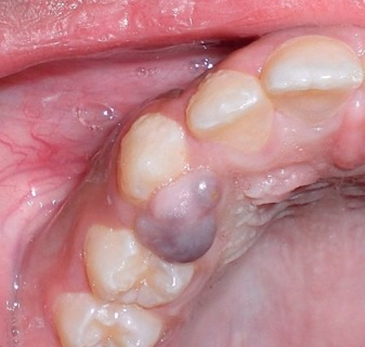 <p>Appearance resembles pyogenic granuloma; Reactive lesion; Contains many multinucleated giant cells, well-vascularized connective tissues, RBCs, & chronic inflammatory cells</p>