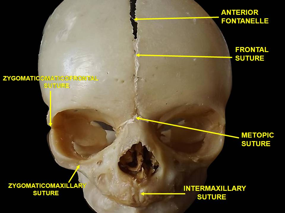 <p>fusion of the two halves of the frontal bones at the metopic suture</p>