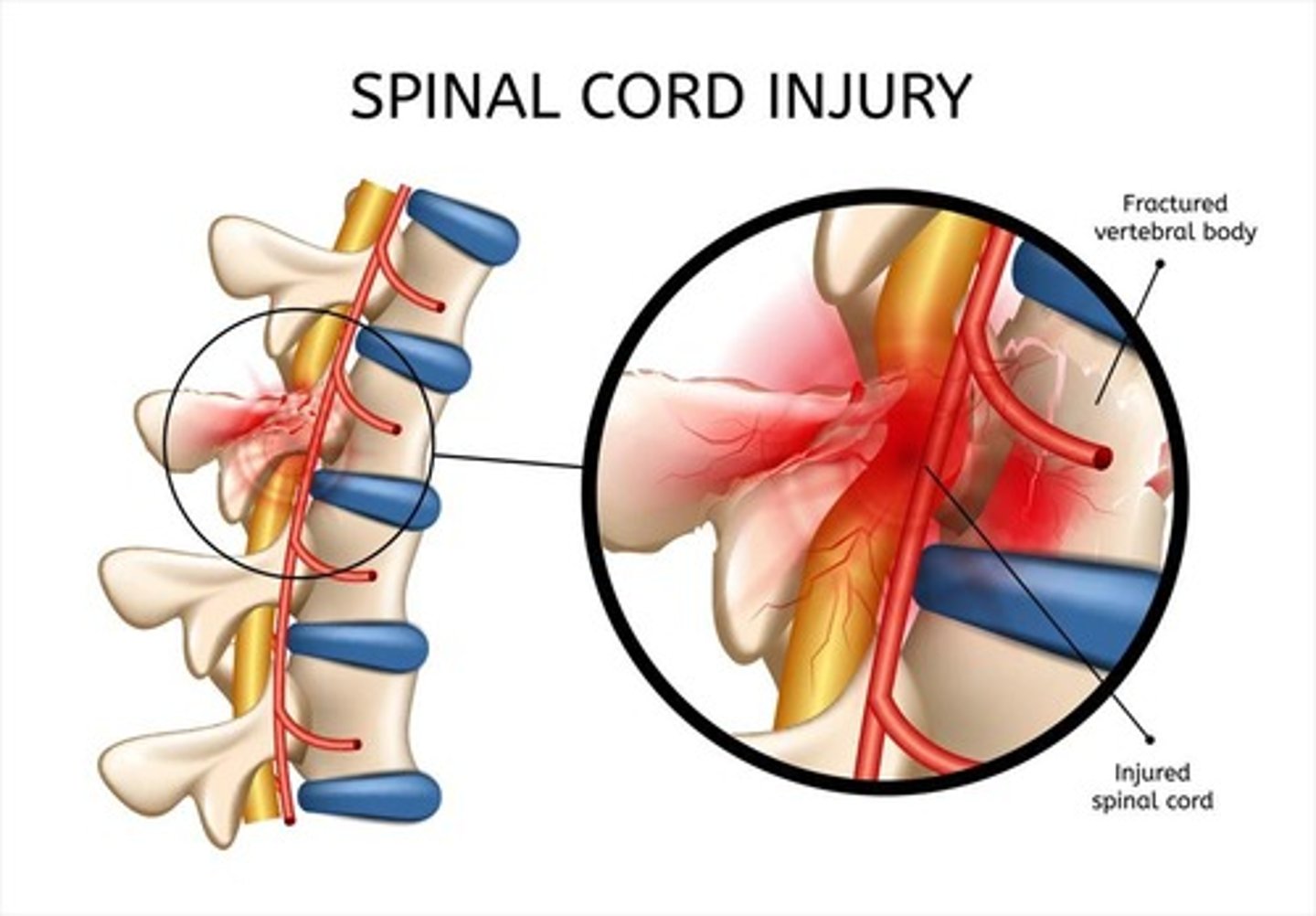 <p>Stabilize the patient, manage damage to the spinal cord, and prevent secondary injuries.</p>