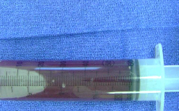 <p><span>What is seen during surgery of an ABC?</span></p>