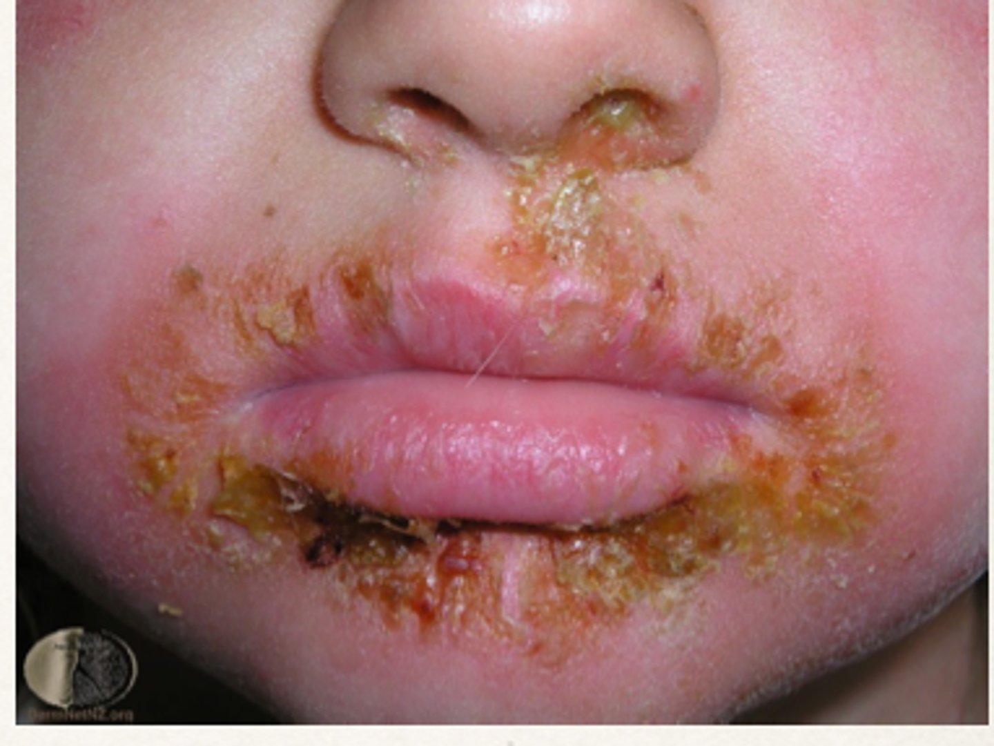 <p>itchy, oozing skin lesions with honey-like appearing crust that peels off</p>