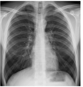 <p>Identify trachei, bronchi, aortic nuckle</p><p></p>