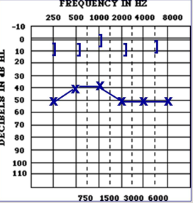 <p>what kind of hearing loss is this  </p><p>AC:</p><p>BC:</p><p>Air bone gap </p>