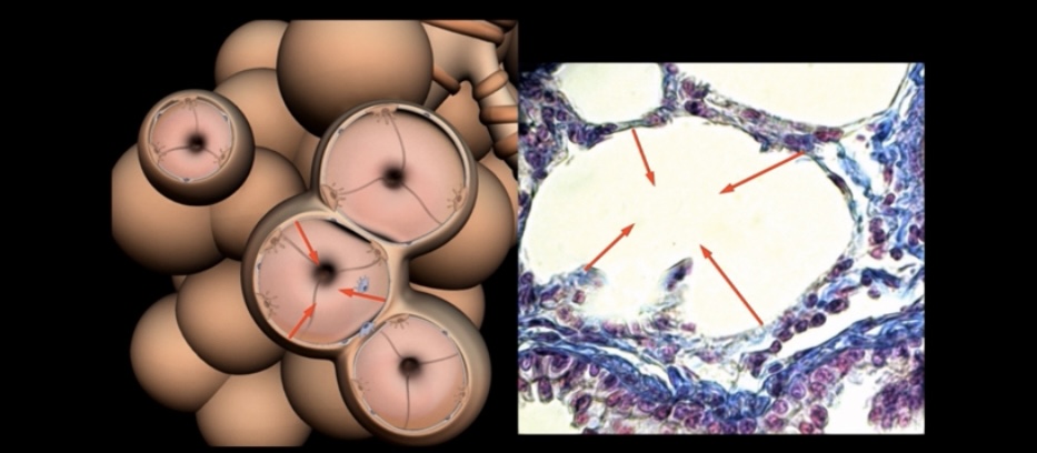 <p>What is the effect of increased alveolar surface tension?</p>