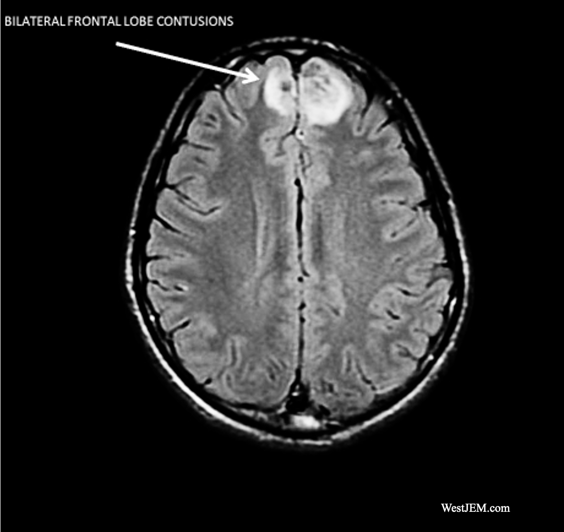 <p>__________ contusions are bruises on both sides of the brain, commonly resulting from coup-contrecoup injuries.</p>