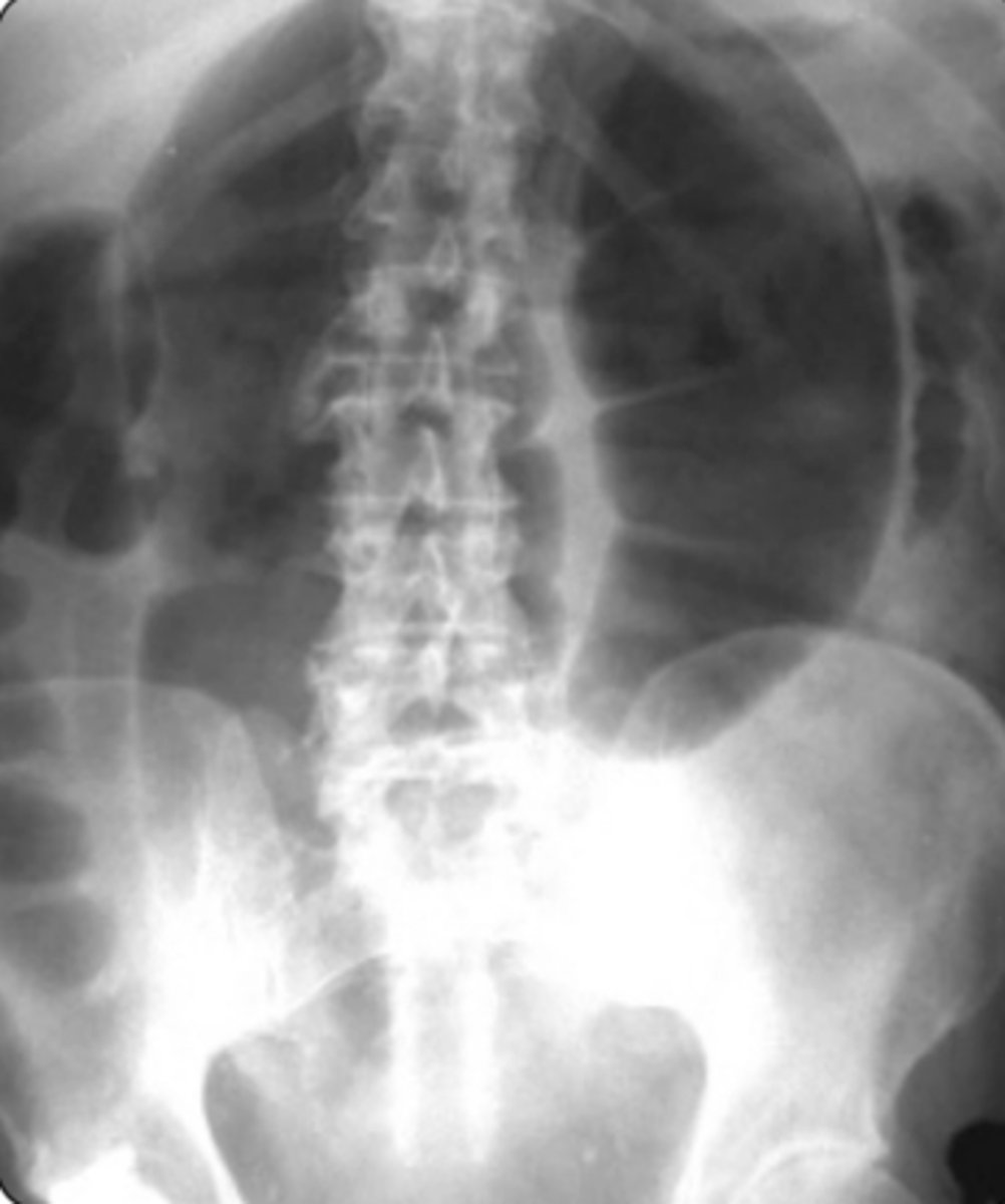 <p>Dx: Plain film x-ray (low specificity): U shaped, bent inner tube</p><p>-> Abd CT scan</p><p>-> Contrast enema</p><p>RF: Long-term care facility</p><p>-> Older age</p><p>-> Bed ridden</p><p>-> Chronic constipation</p><p>Clinical: Insidious onset of abdominal pain</p><p>-> Abdominal distention</p><p>-> Nausea, Vomiting, Constipation</p><p>Management</p><p>- Flexible sigmoidectomy (to reduce volvulus)</p><p>-> Surgery (to prevent recurrence)</p>