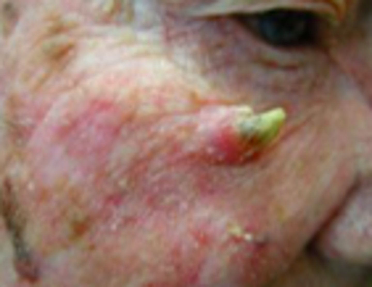 <p>Keratotic Disorders:</p><p>Objective:</p><p>- Diagnosed by its appearance but histological exam of the horn base is crucial to rule out malignancy</p><p>- Generally presents as straight or curved, hard, yellow-brown projection from the skin</p><p>- Usually singular but can be multiple</p><p>- Common in sun-exposed areas</p>