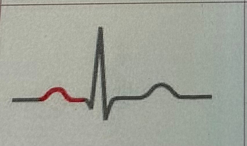 <p>time it takes for SA node depolarization to spread through ventricles </p>