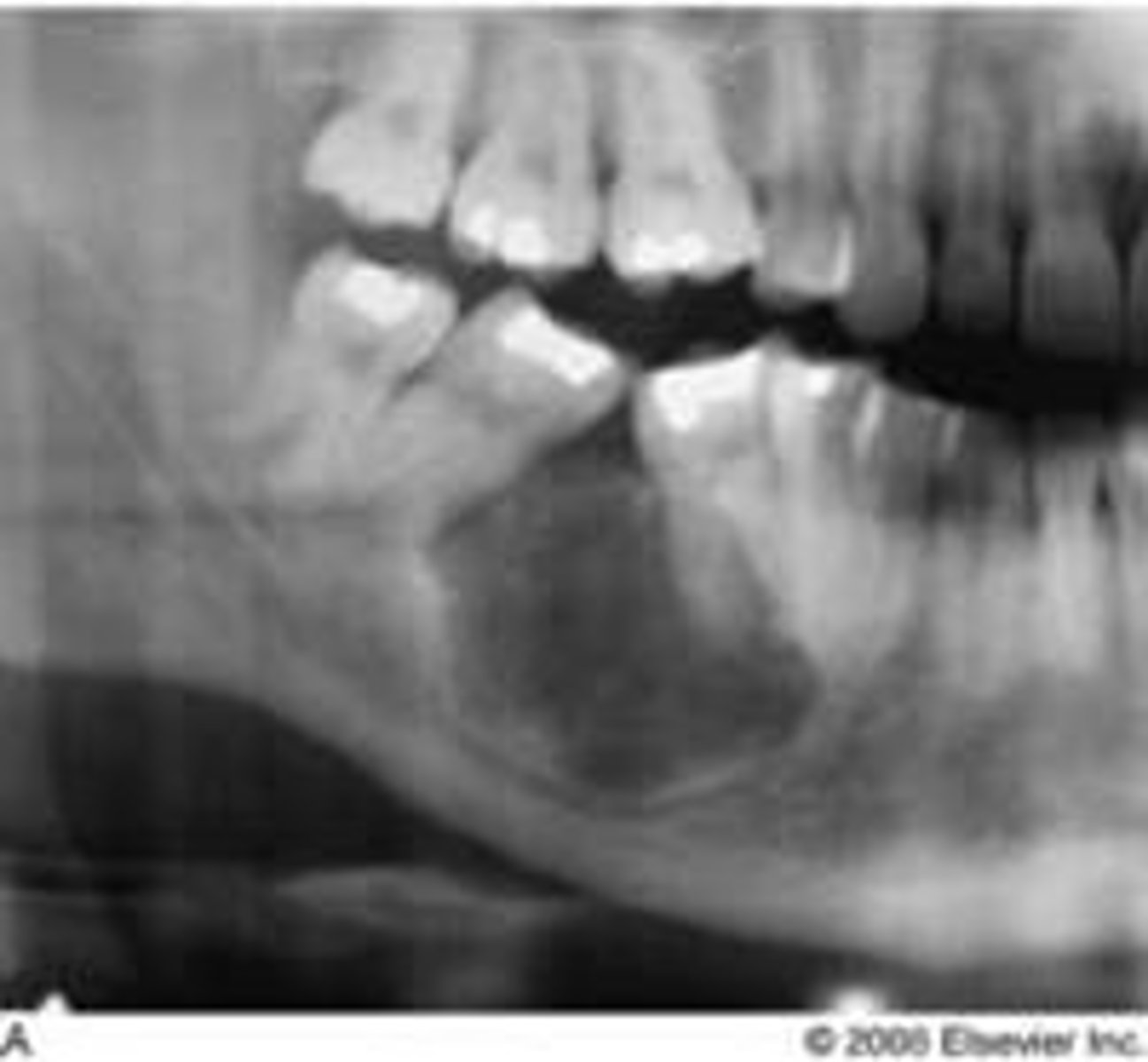 <p>common locations: posterior mandible</p><p>clinical features: expansion + divergence</p><p>radiographic: well-defined unilocular radiolucency w opaque flecks</p><p>population: YA 20-30s</p>