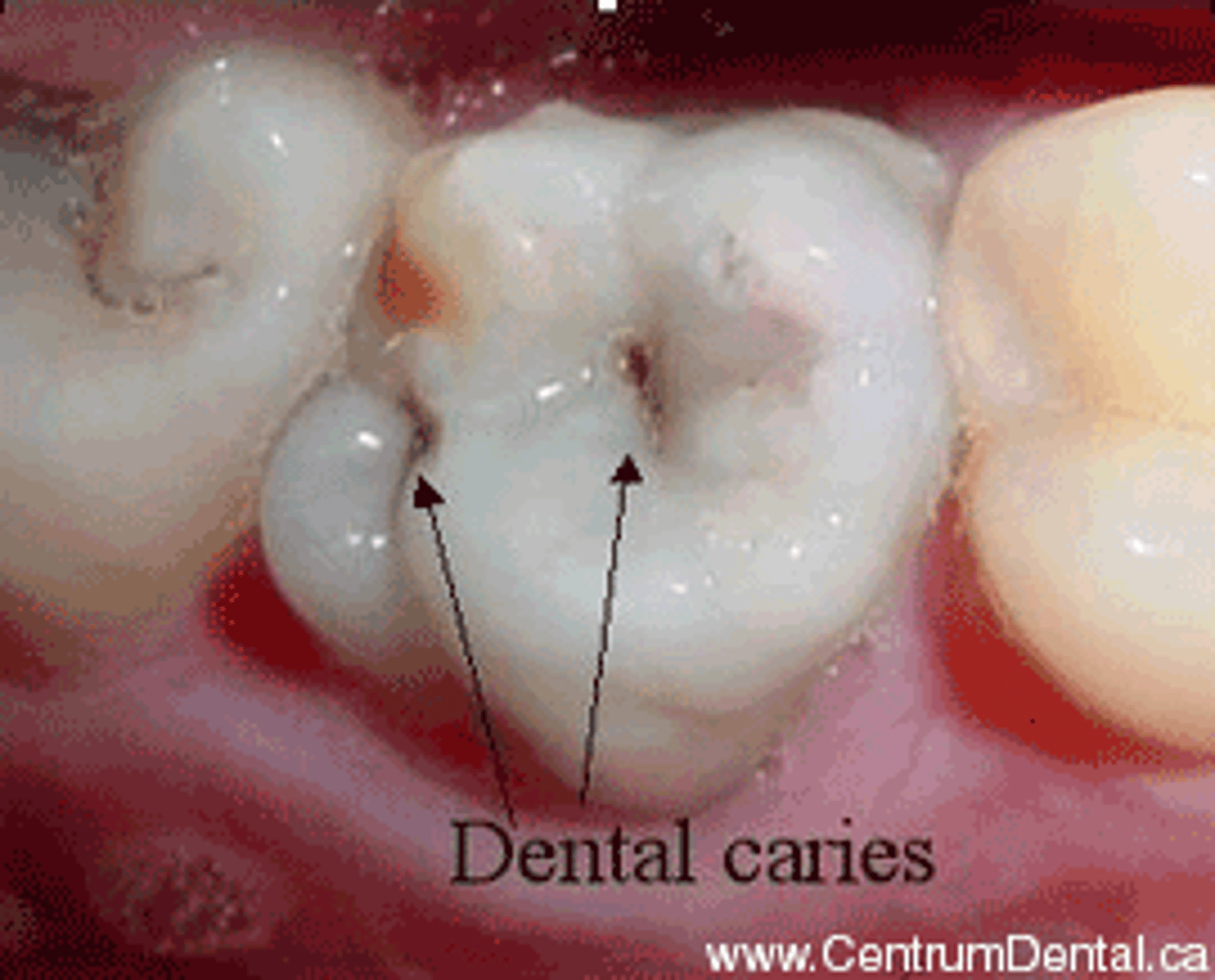 <p>cavities due to decay of the enamel of teeth</p>